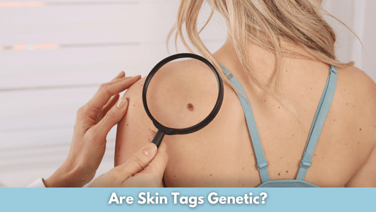 Are Skin Tags Genetic?