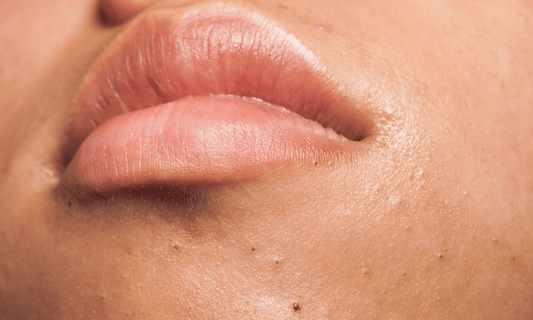 Blackheads on Lip Line of Woman