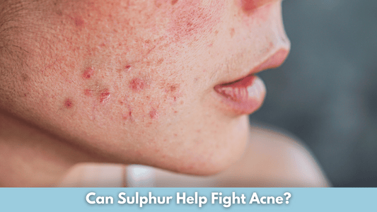 Can Sulphur Help Fight Acne?