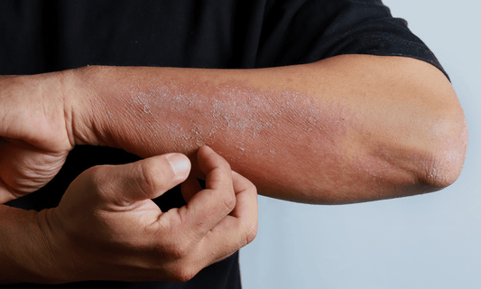Eczema on Mans Arm