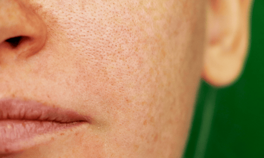 Enlarged Pores on Womans Skin