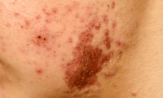 Facial Fungal Acne
