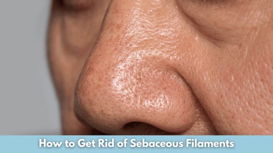 How to Get Rid of Sebaceous Filaments