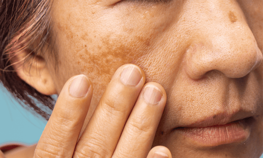 Melasma on Face