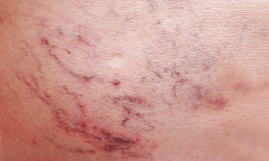 Mottled Skin on Leg