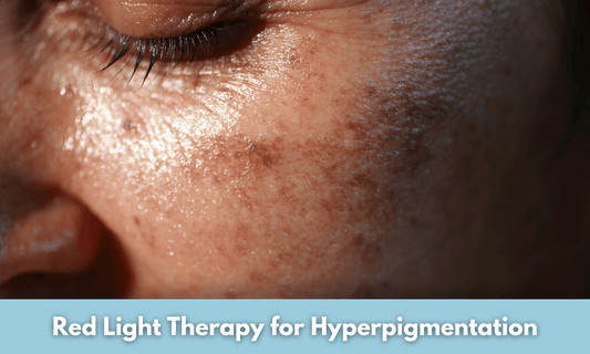 Red Light Therapy for Hyperpigmentation