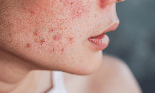 Stress Rash