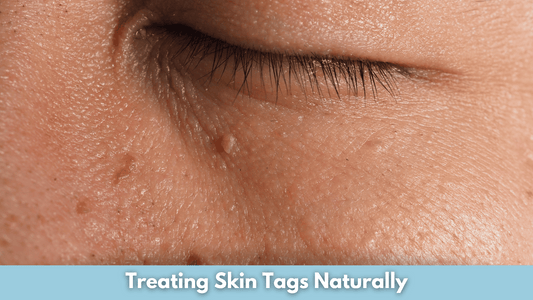 Treating Skin Tags Naturally