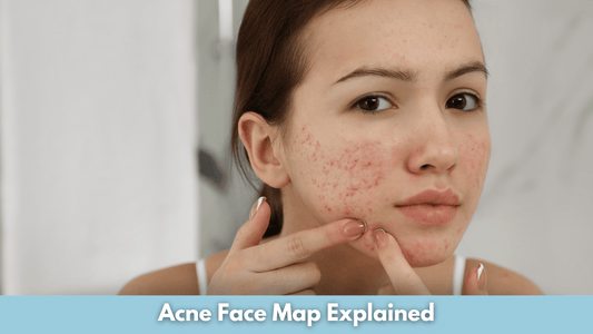 Acne Face Map Explained
