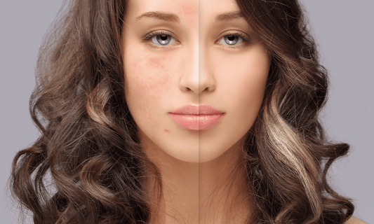 Acne Purge on Woman