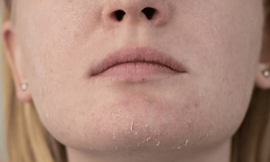 Alipidic Skin Concern on Face