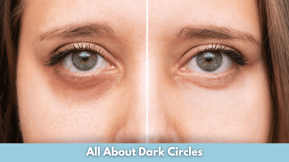 All About Dark Circles