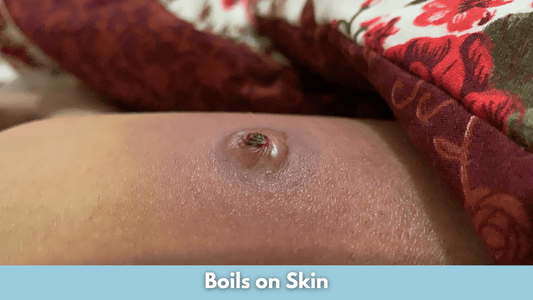 Boils on Skin