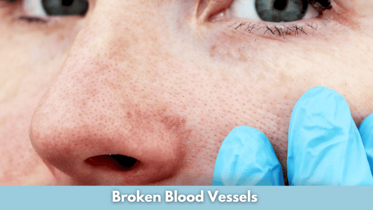 Broken Blood Vessels on Nose