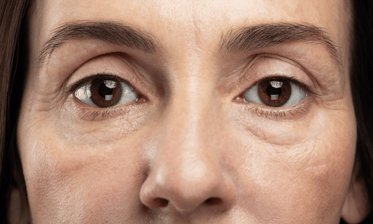 Facial Veins on Womans Face