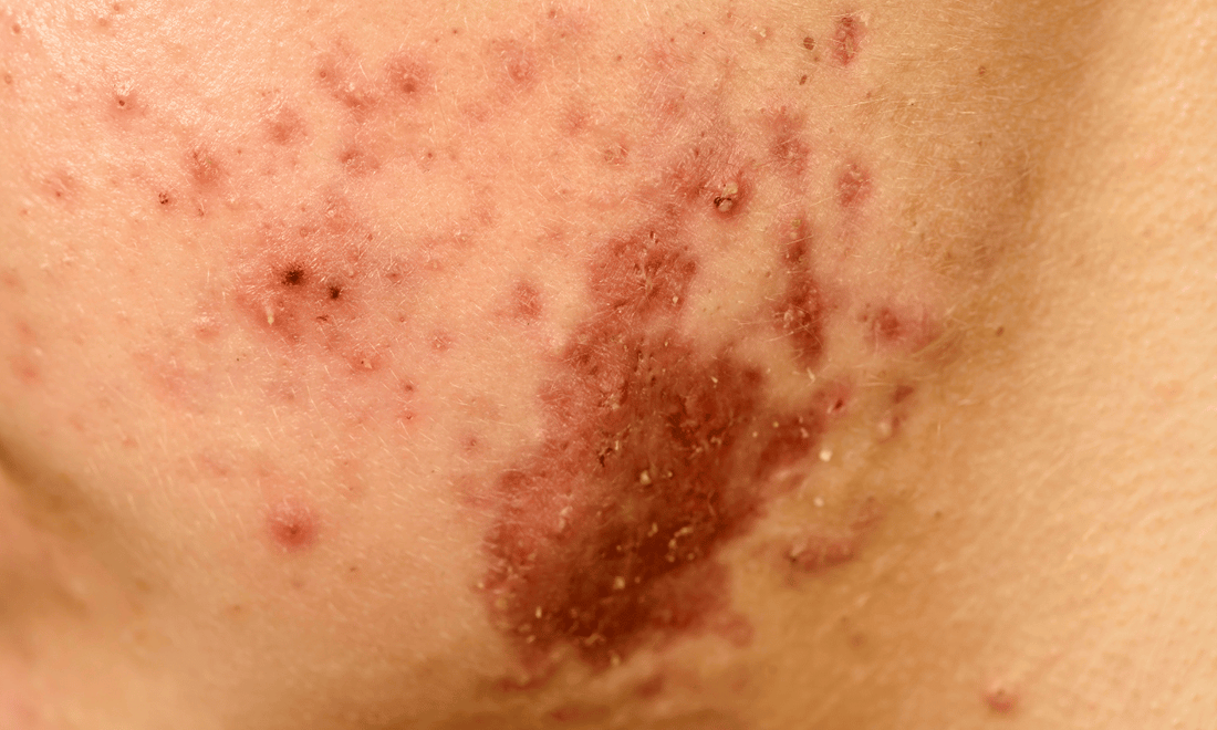 Facial Fungal Acne
