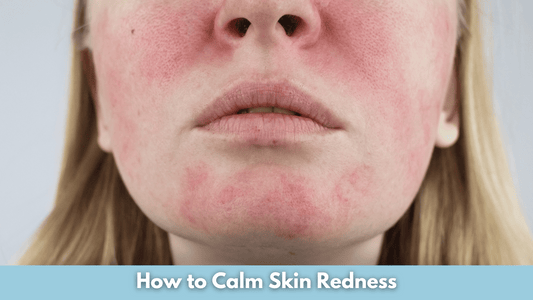 How to Calm Skin Redness