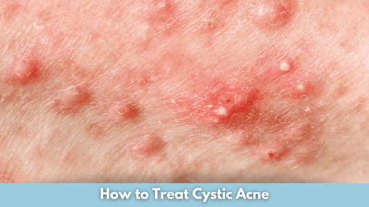 How to Treat Cystic Acne