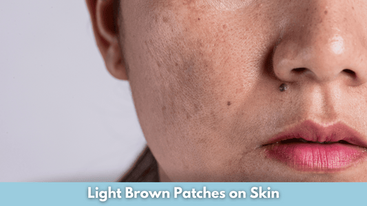 Light Brown Patches on Skin