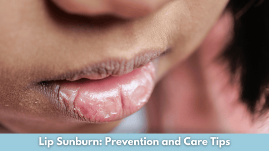 Lip Sunburn: Prevention and Care Tips