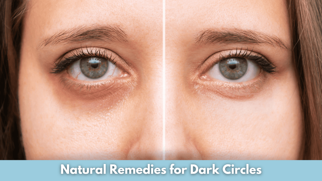 Natural Remedies for Dark Circles