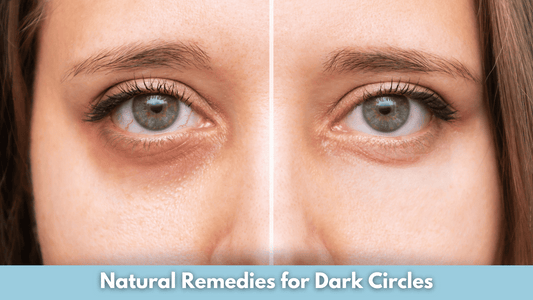Natural Remedies for Dark Circles