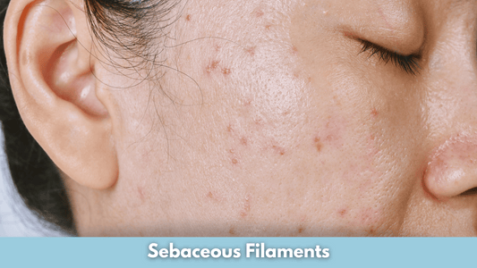 Sebaceous Filaments