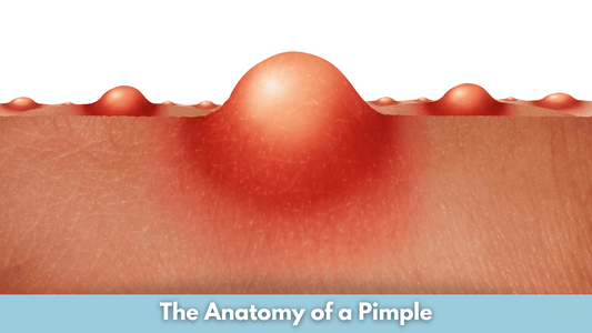 The Anatomy of a Pimple