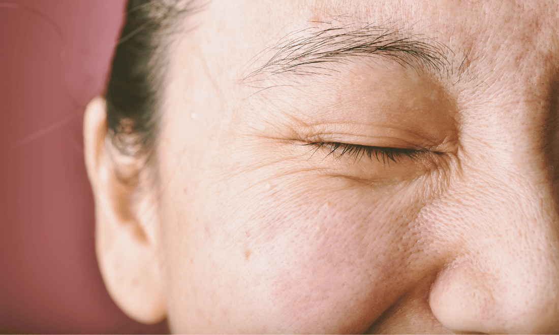 Woman with Textured Skin