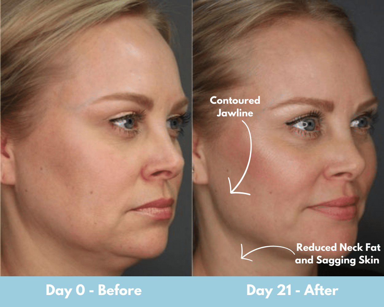 Micro Roller Before and After